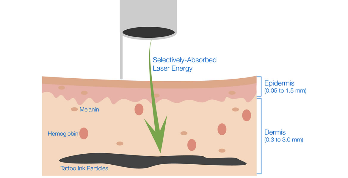 ¿Cómo realiza el láser la rotura del pigmento de tinta?